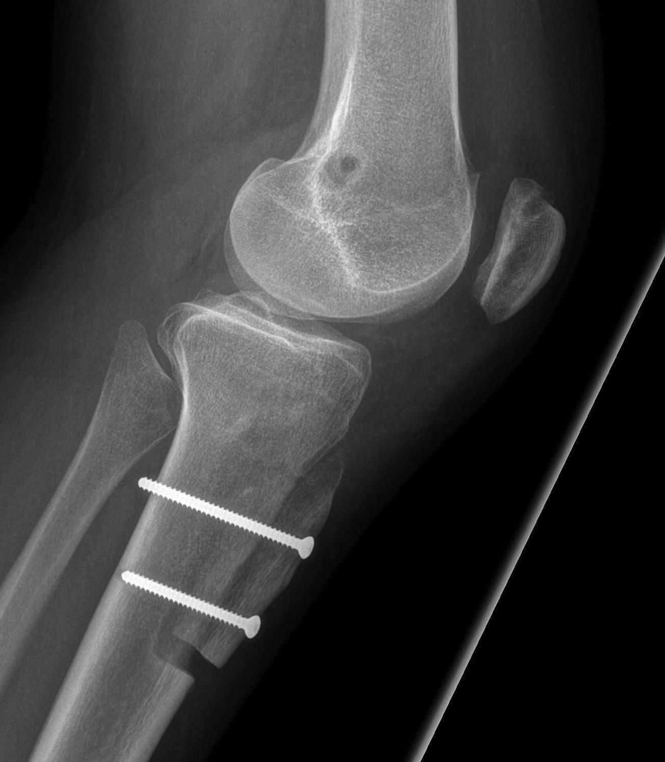 Chronic Patella Dislocation